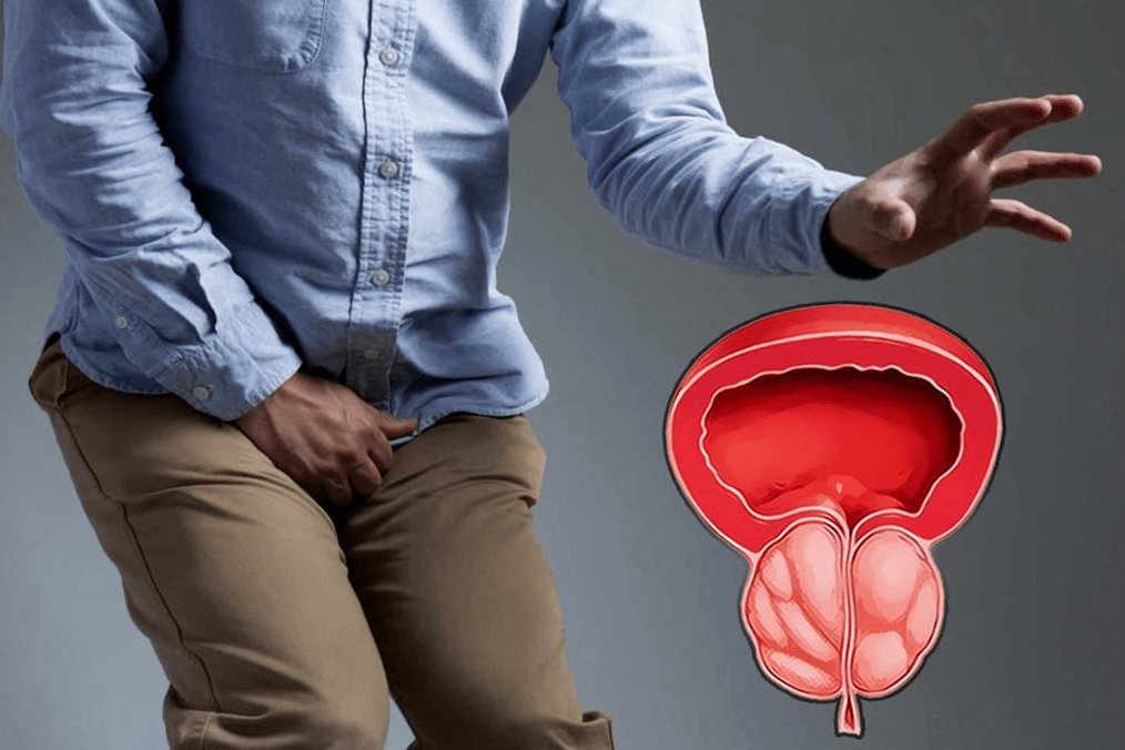 Prostatite e suo trattamento con capsule Weiprost